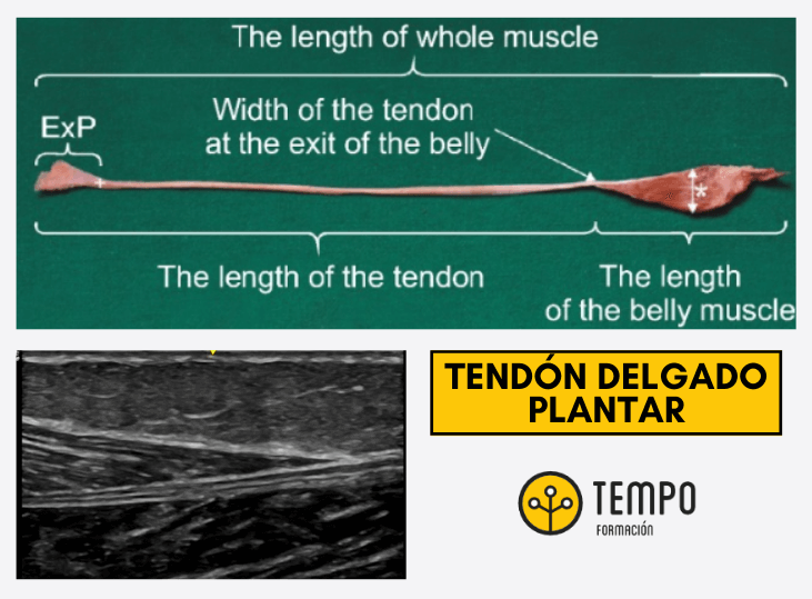 tendon-delgado-plantar-que-sabemos